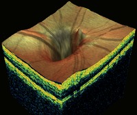 OCTglaucoma disk