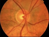 Glaucoma Roma pap2b