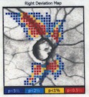 Glaucoma Roma slp